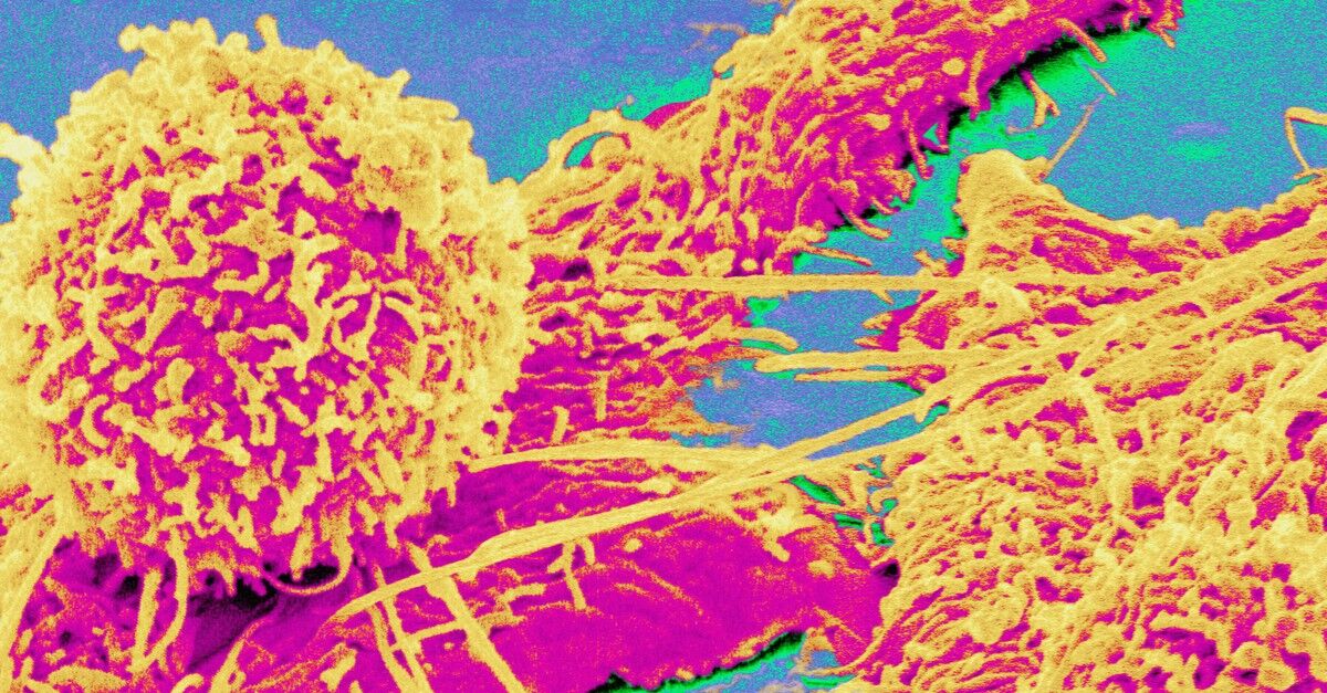 Scanning electron micrograph of a colon cancer cell