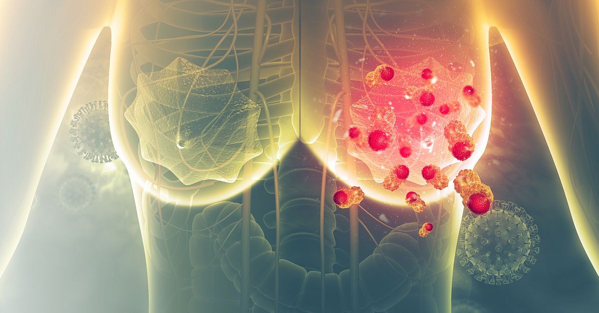 CDK4/6 Inhibitors Best Option for Metastatic HR+, HER2– Breast