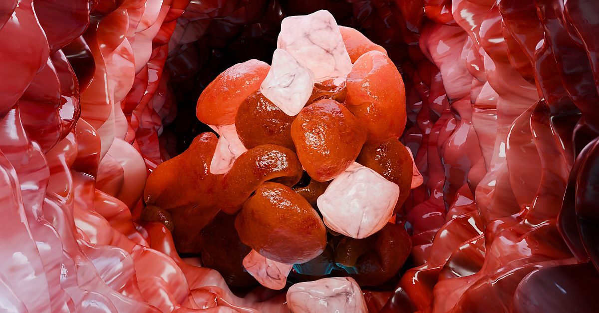 Prof Grigoris Gerotziafas of Paris shares insights on risk assessment and prophylactic management of venous thromboembolism in patients with cancer
